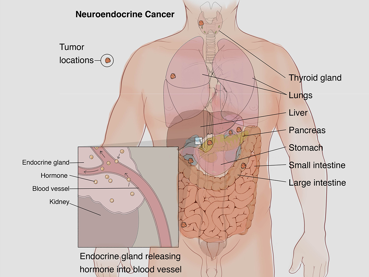 Neuroendocrine Tumors (NET's)- What it is, What are its risk factors, causes, treatment and more